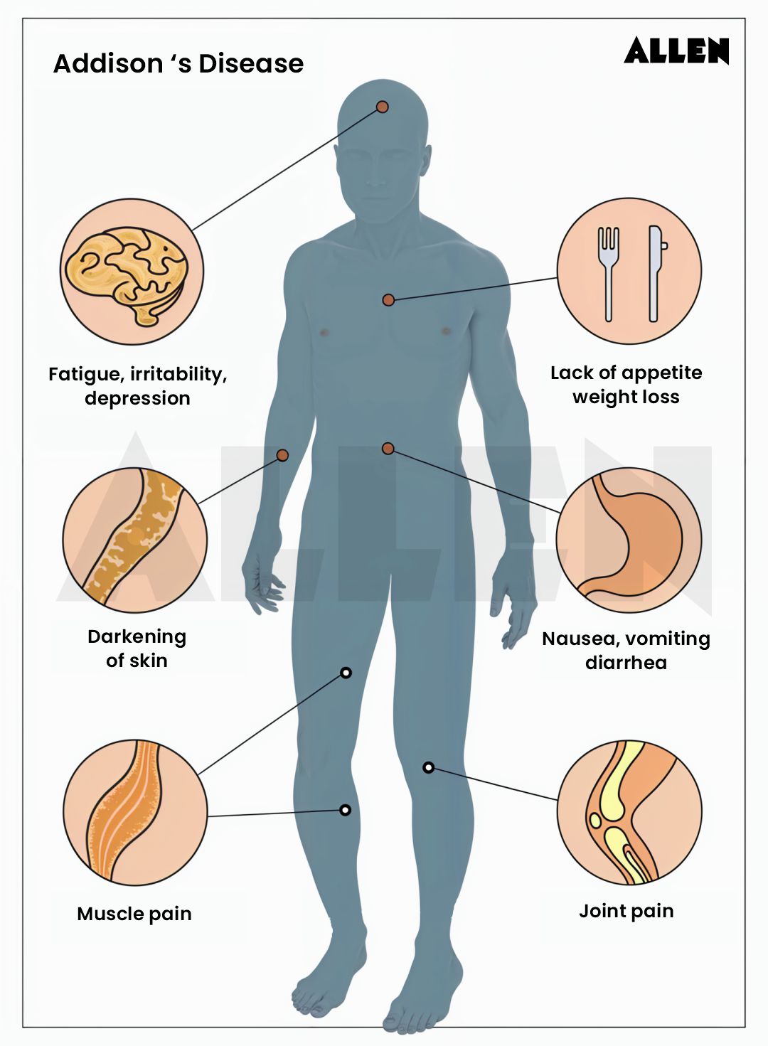 Addisons disease