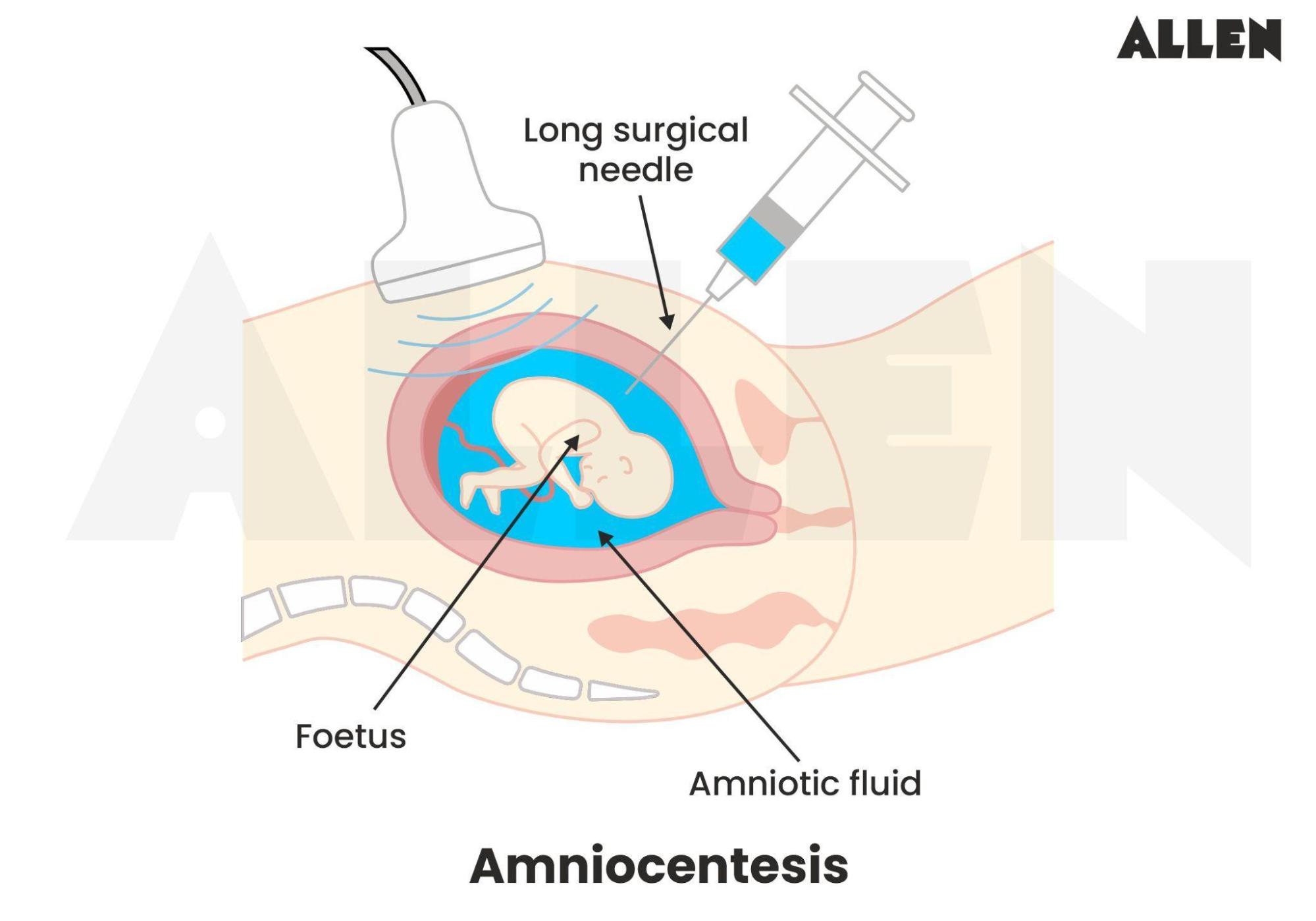 Amniocentesis