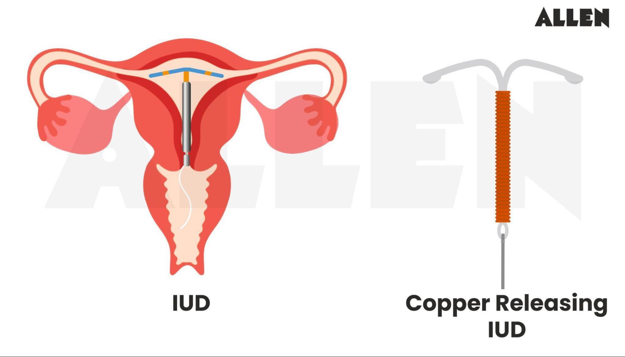 Copper releasing IUDs
