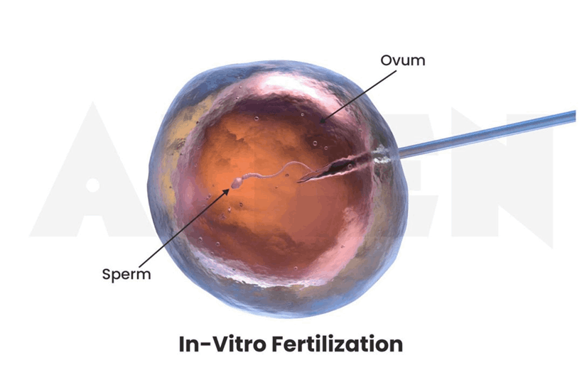 Invitro fertilization