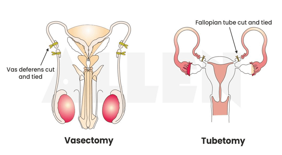Vasectomy and Tubectomy