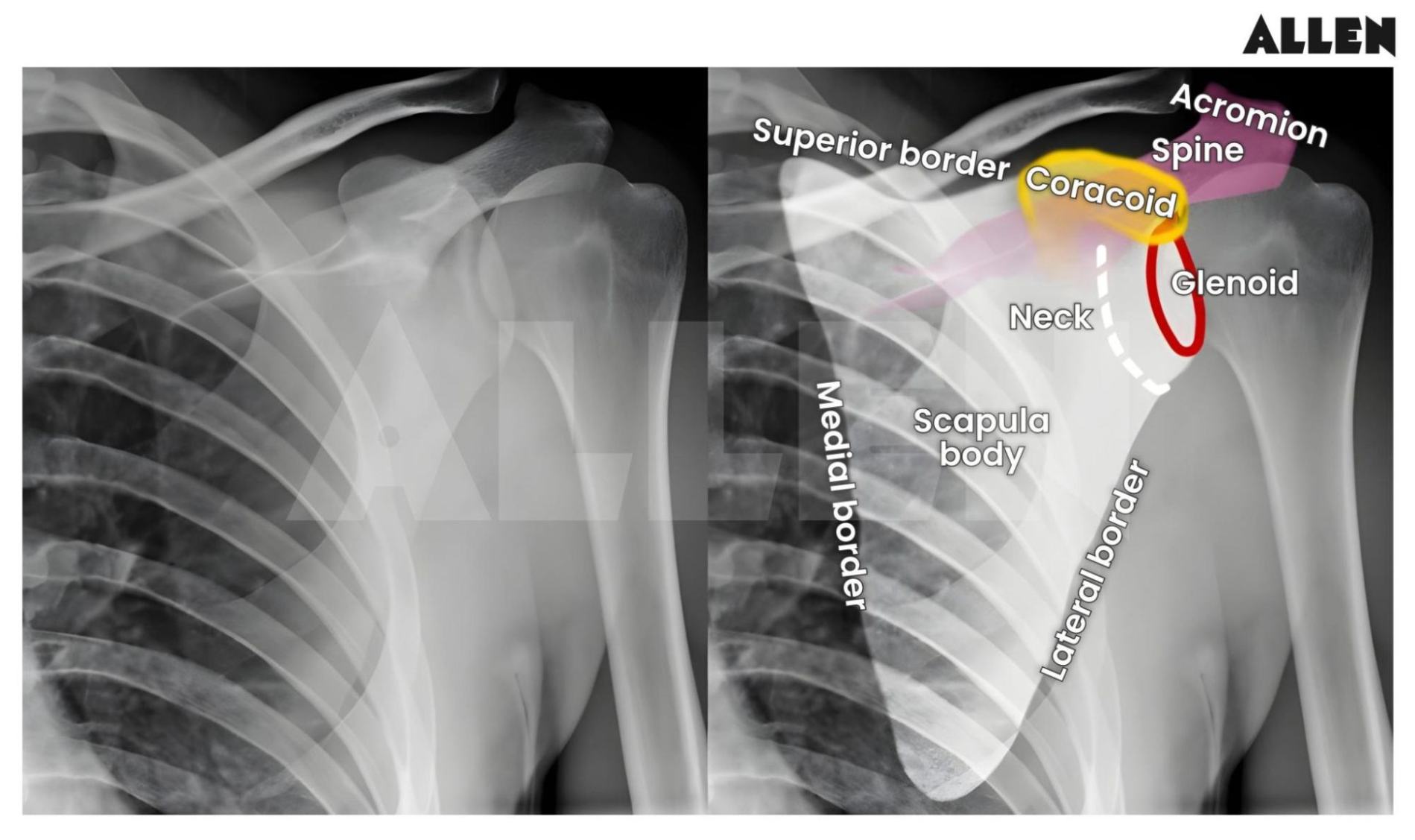 Glenoid and Caracoid