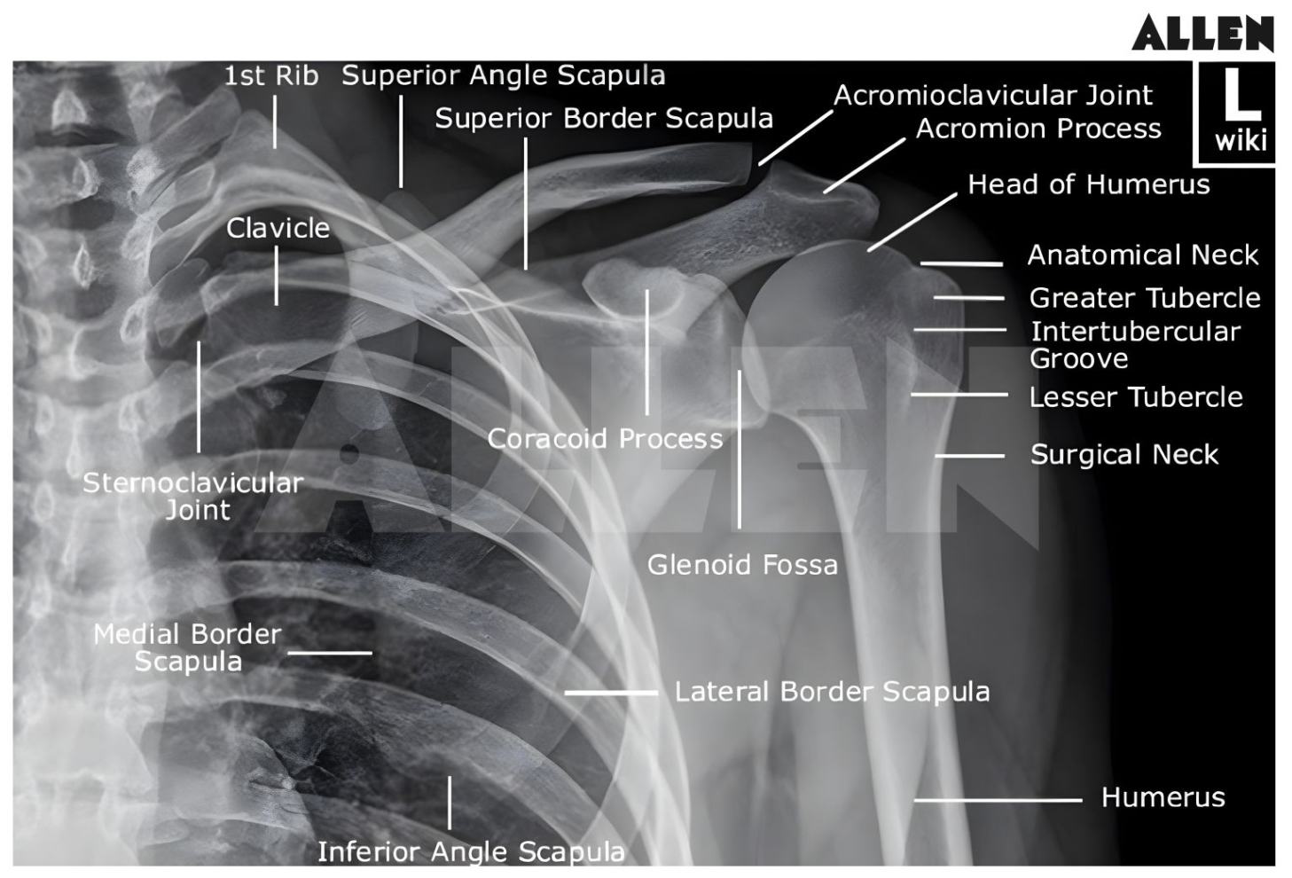 X ray image of scapula