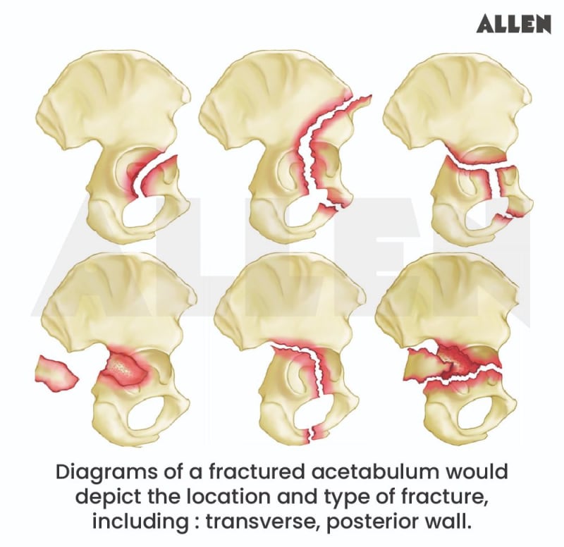 Acetabulum Rotation Acetabulum: Function, Types and FAQs