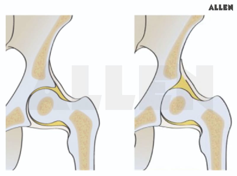 Acetabulum Rotation Acetabulum: Function, Types and FAQs