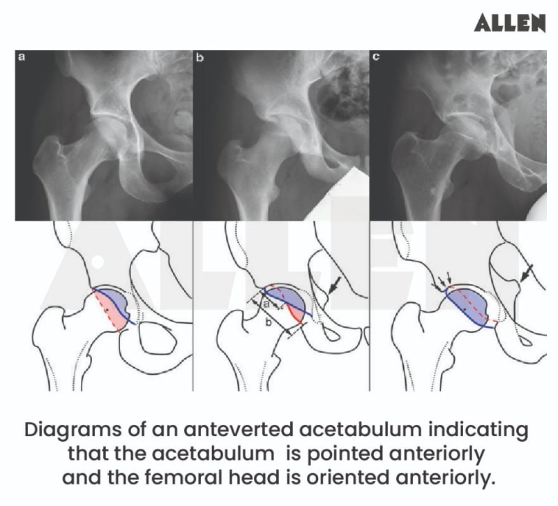 Ht Acetabular Acetabulum: Function, Types and FAQs