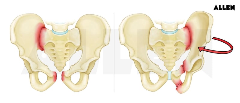 Ischium: Anatomy, Functions and Clinical Relevance