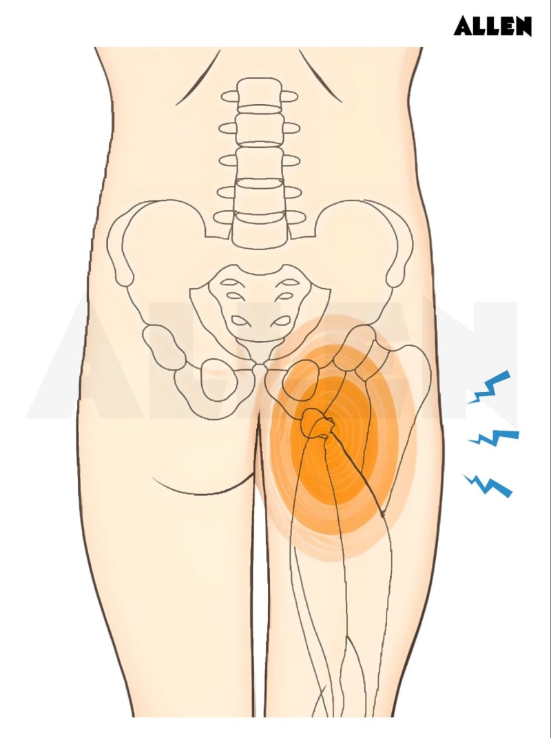 Ischium: Anatomy, Functions and Clinical Relevance