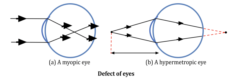 Defects of Vision| Myopia, Hypermetropia, and Presbyopia Explained