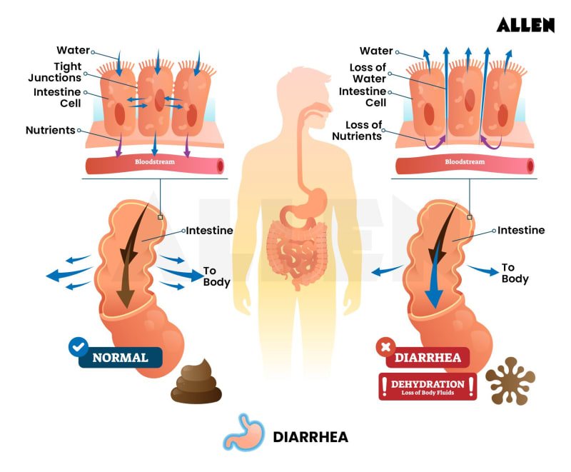 Diarrhoea| Types, Causes, Symptoms, Prevention, and Treatment