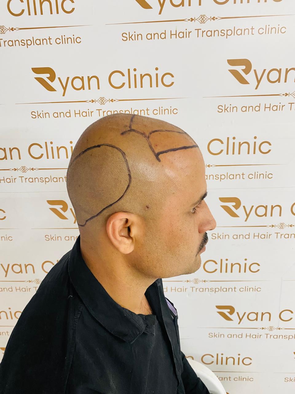 Best Hair Transplant Surgery in Bangalore