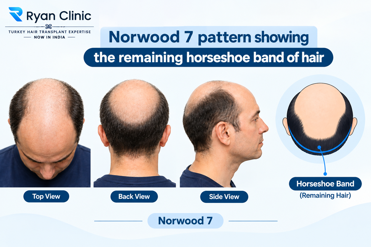Norwood 7 pattern showing the remaining horseshoe band of hair