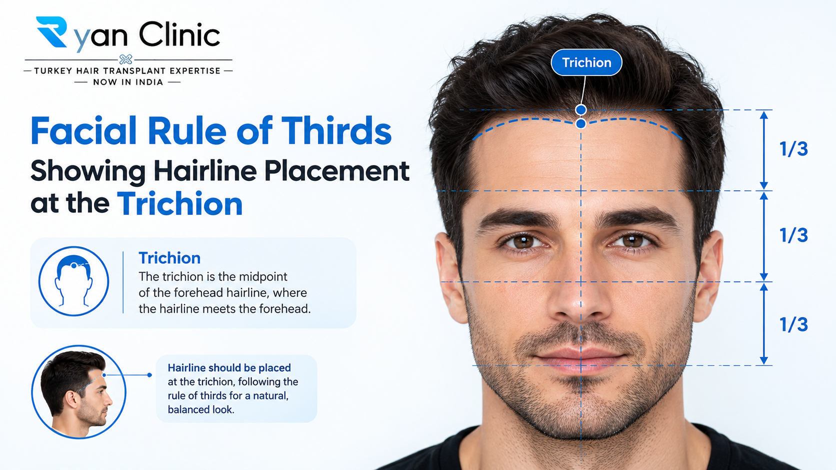 Facial rule of thirds showing hairline placement at the trichion