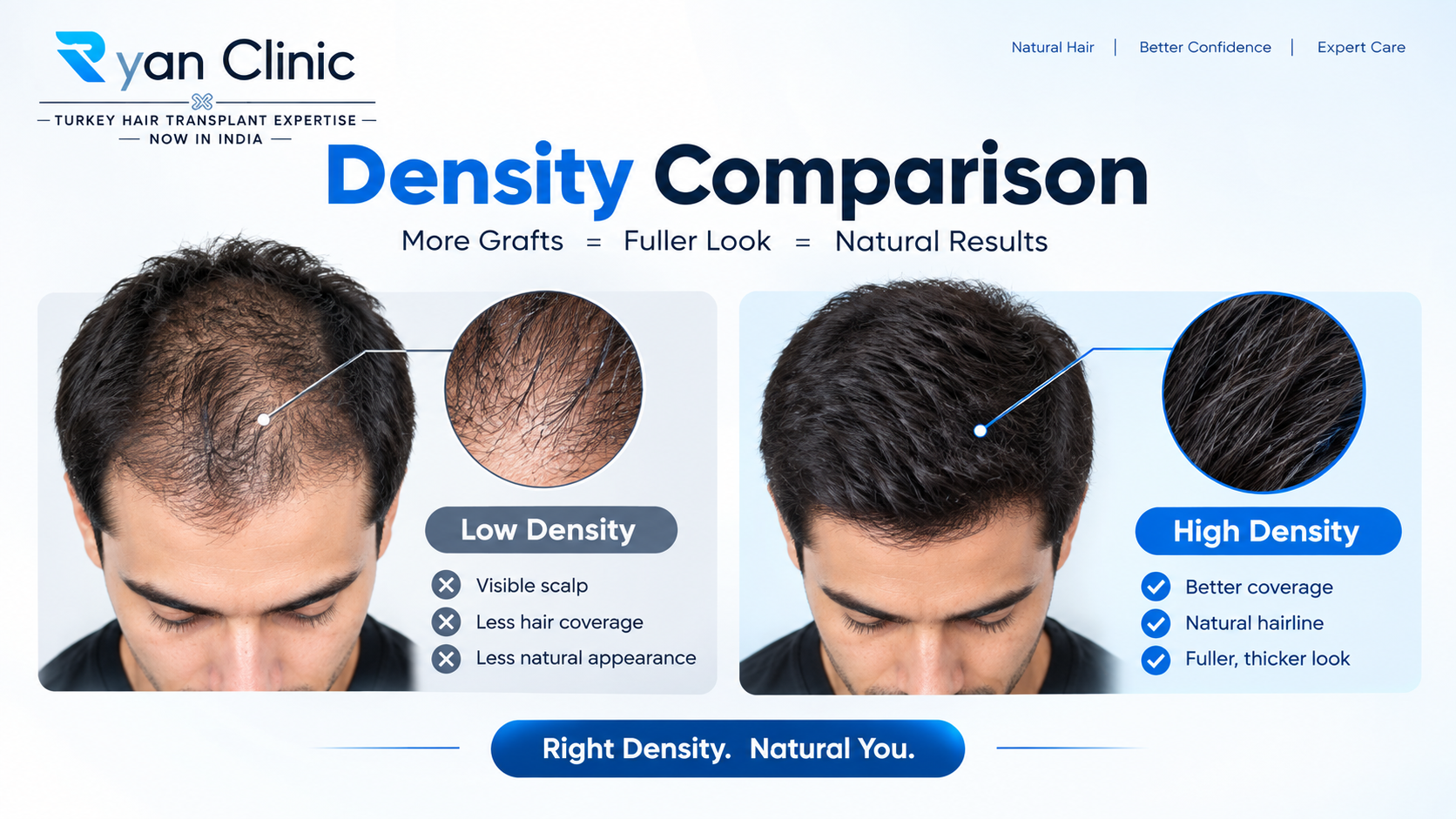 Hair transplant density comparison at 20, 30, 40 and 50 grafts per square cm