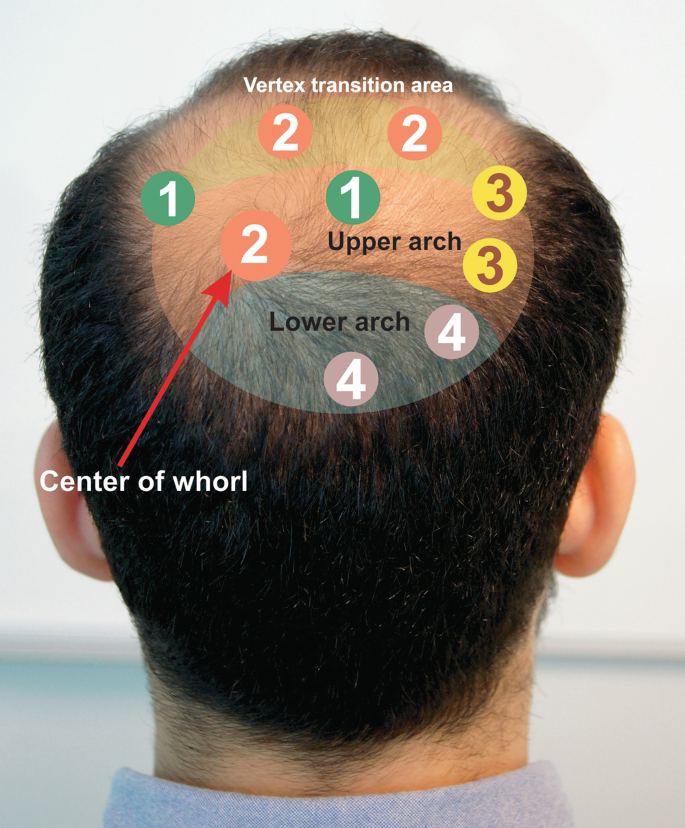 influencer marketing agency in delhi related to hair transplant