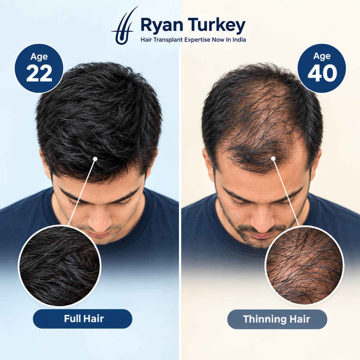 Why a hair transplant at 22 can look wrong by age 40