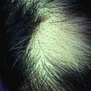 Alopecia areata patch compared with pattern hair loss