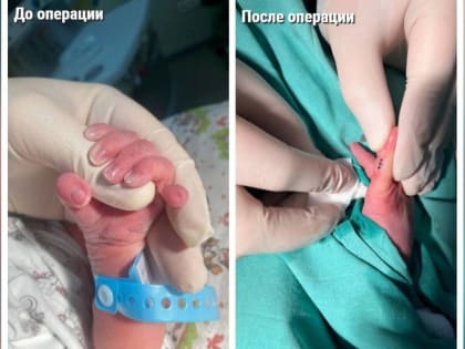 Подмосковные врачи удалили новорождённому шестой палец
