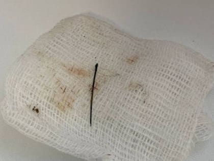 Жить мешала! В Твери хирурги удалили из легкого женщины швейную иглу