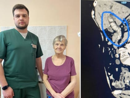 В Твери 85-летней пациентке успешно провели опасную операцию по удалению камней из желчных протоков