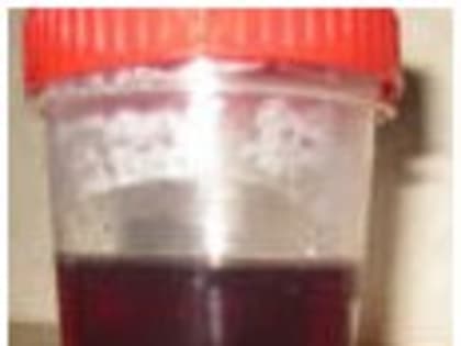 Пироплазмоз