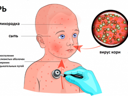 Внимание, корь!