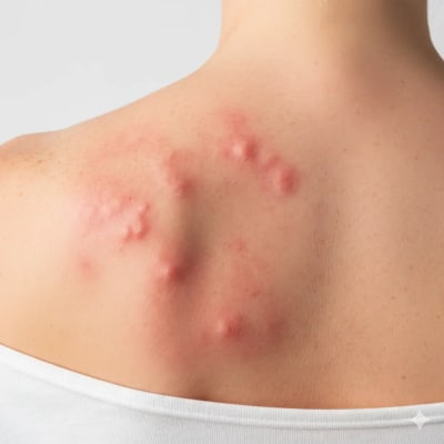 Dermatology