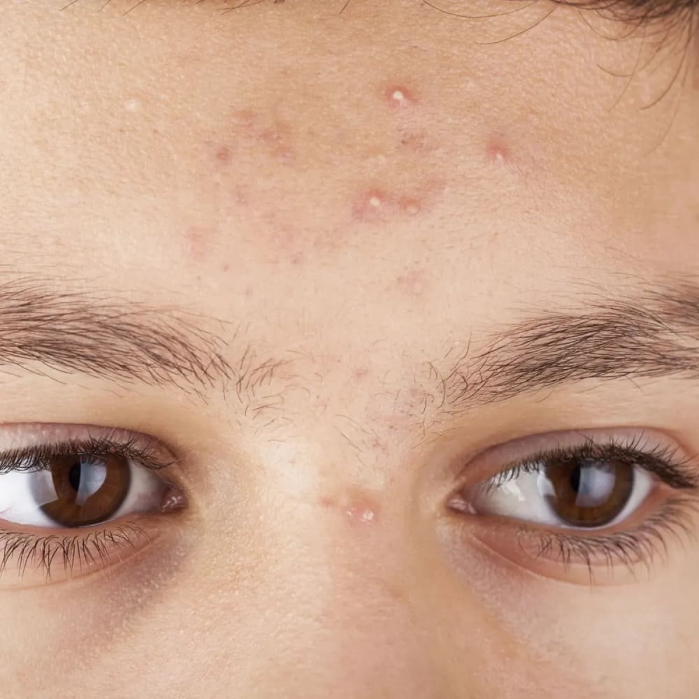 Acne (Mild–Moderate) - Men