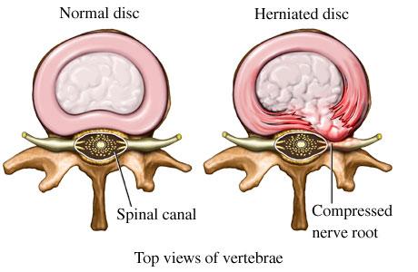 A healthy and a herniated disc A healthy and a herniated disc, showing the normal pattern of damage.