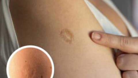 Here's The Truth Behind This Scar On People's Upper Left Arm