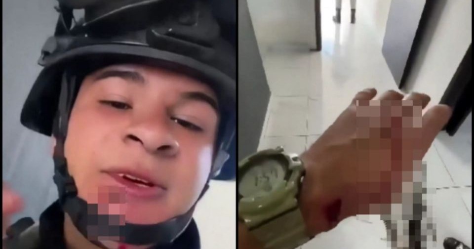 Elemento de la Guardia Nacional sobrevive a ataque con bala incrustada en el labio