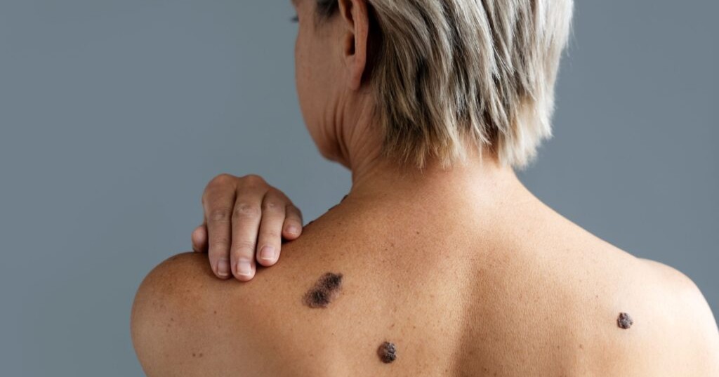 Día Mundial del Melanoma Cutáneo: presta atención a las señales antes de que sea tarde