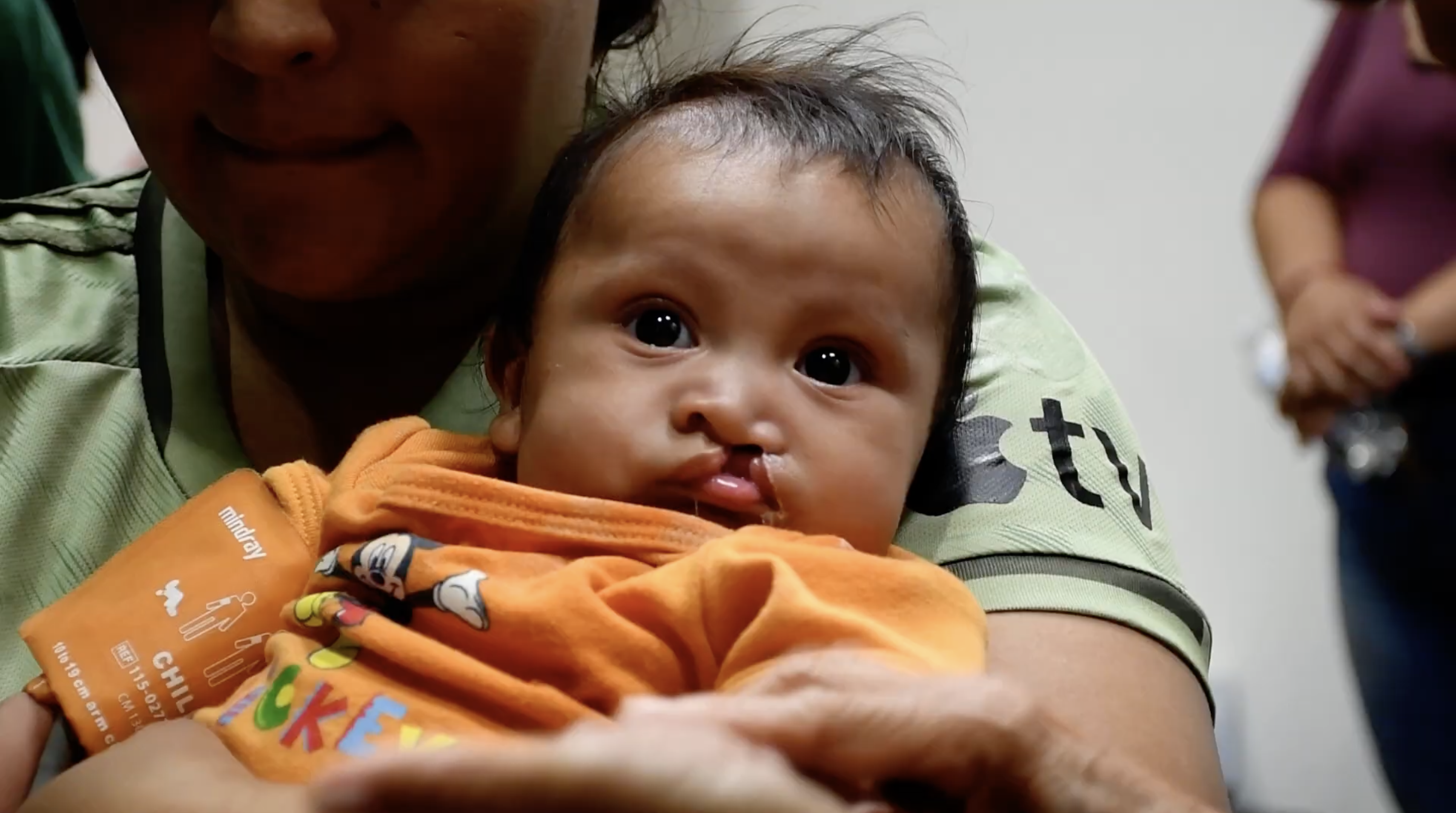 Infant treated by Operation Smile