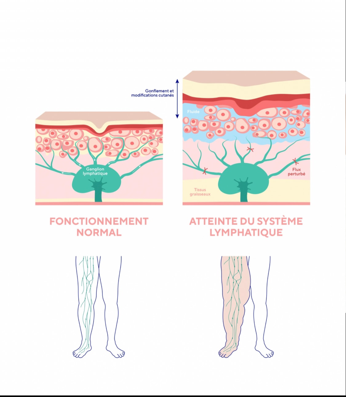 Image lymphe