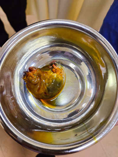 Removed Gallbladder Specimen in Surgical Bowl, Cairo