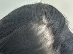 Девушка облысела после популярной косметической процедуры