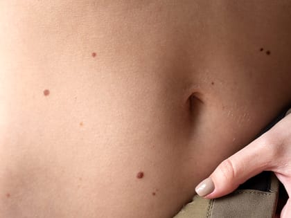 На какие родинки нужно обращать пристальное внимание, рассказала онколог