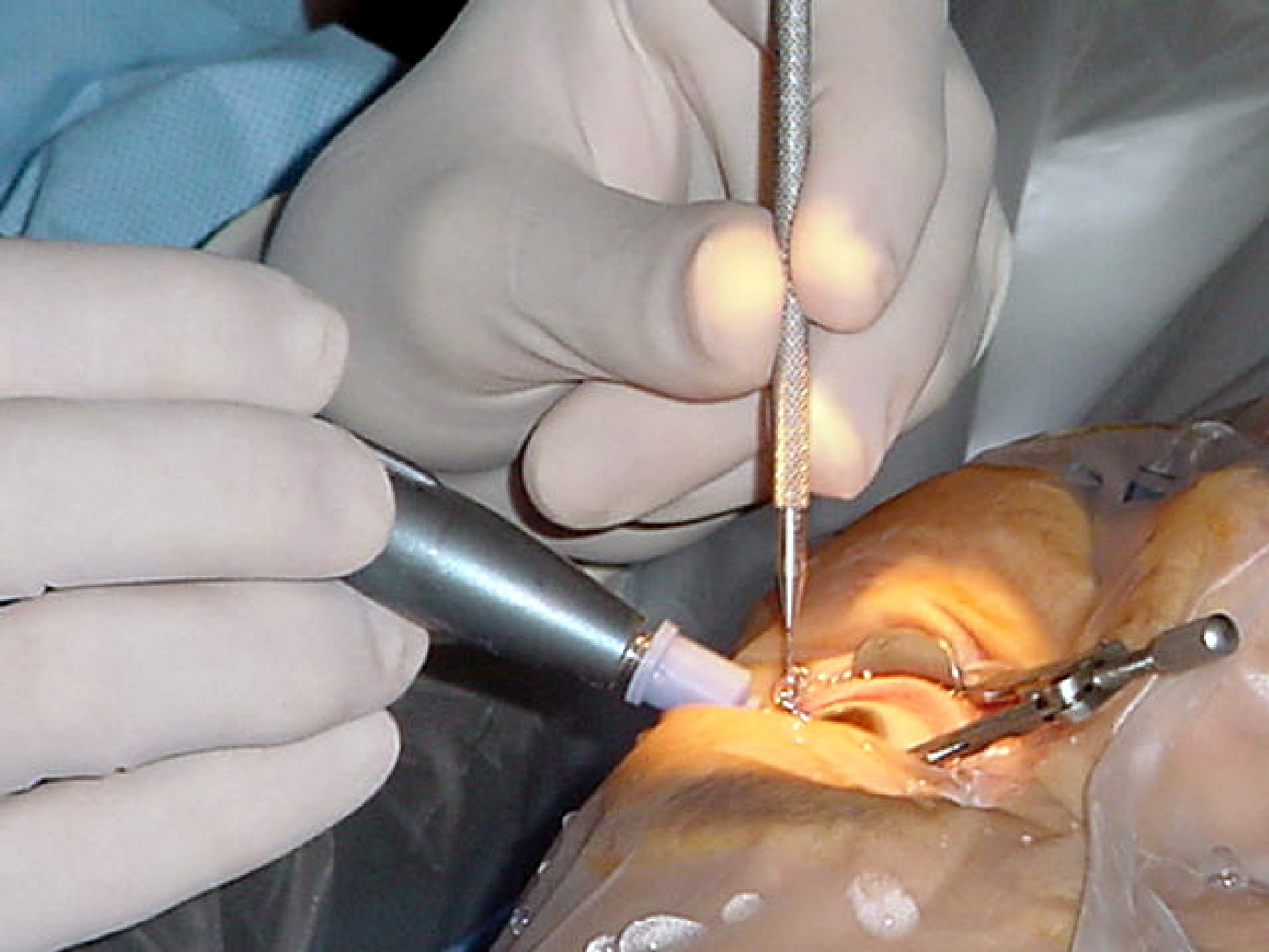 Cataract Surgery at Kiran Eye Care Hospital