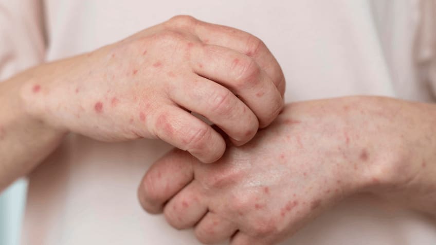 hand foot mouth disease