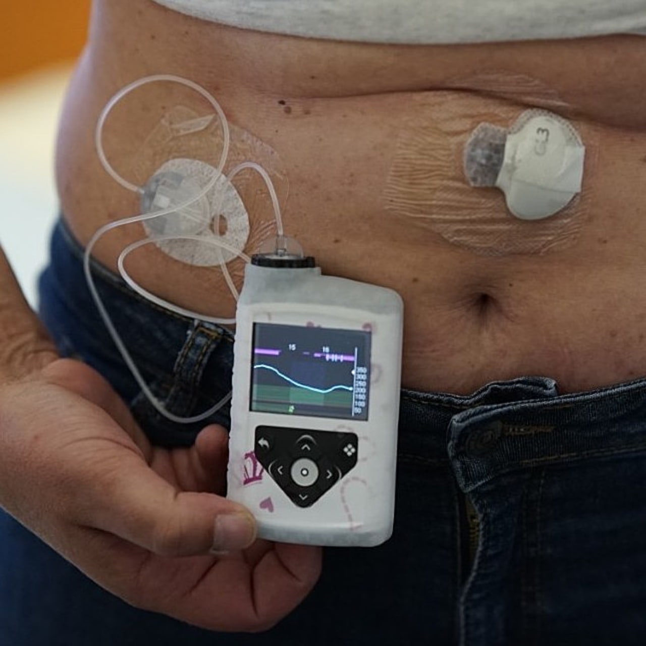 Le CH de Perpignan défriche la voie du pancréas artificiel.