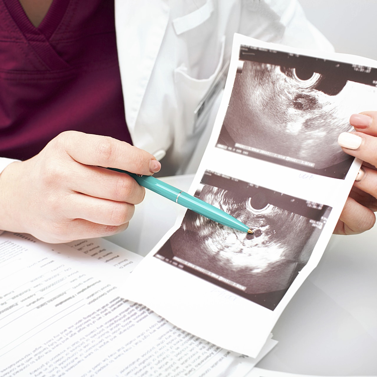 Pour les 10% de Françaises touchées par l'endométriose, l'accès précoce à des soins pluridisciplinaires de qualité est essentiel au regard de la complexité diagnostique et de prise en charge liée aux différentes dimensions de la maladie.