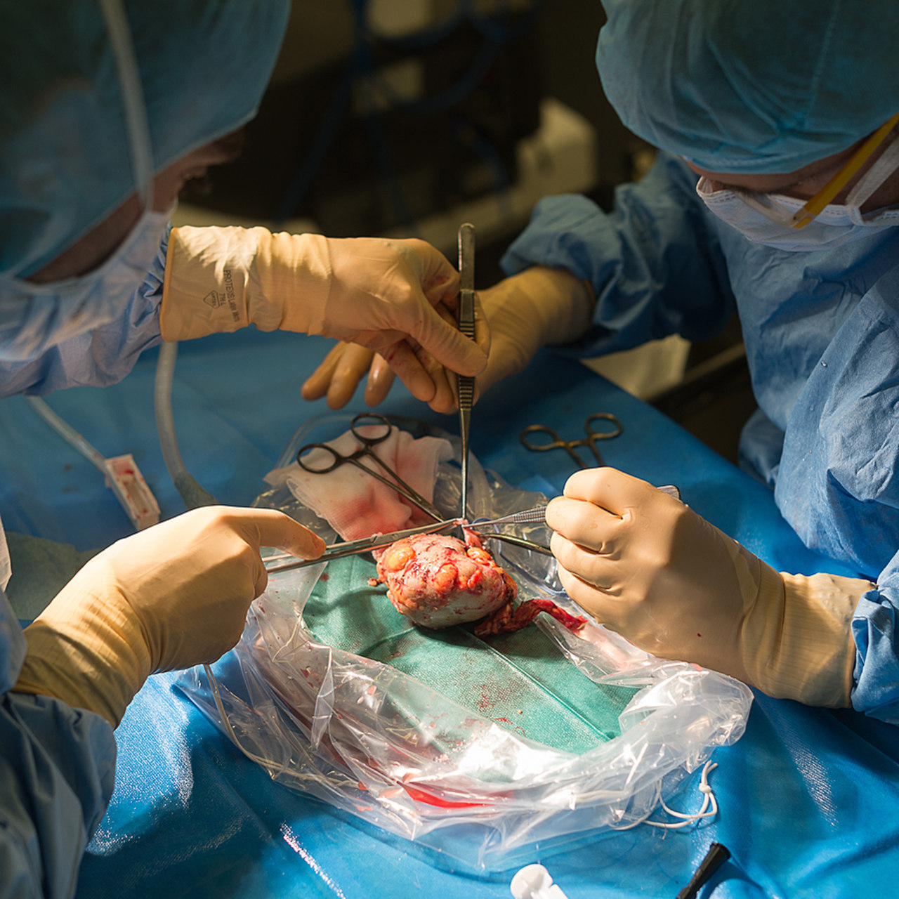 3 525 greffes de rein ont été réalisées en 2023 dont 557 à partir de donneurs vivants, contre respectivement 3 377 et 514 greffes en 2022. Un niveau d'activité en deçà de celui qui existait avant la crise sanitaire. (A. Noor/Image Point FR/BSIP)