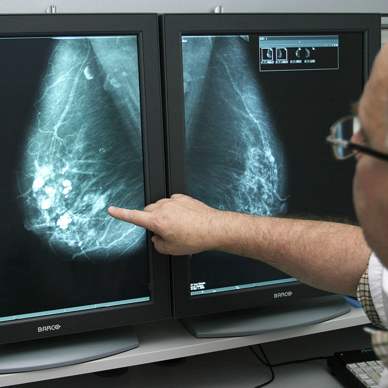 Les médecins radiologues et chercheurs élaborent de nouveaux modèles basés sur des outils mathématiques (radiomique) ou d'intelligence artificielle pour prédire la réponse des cellules tumorales à la chimiothérapie ou à l’immunothérapie. (Mendil/BSIP)