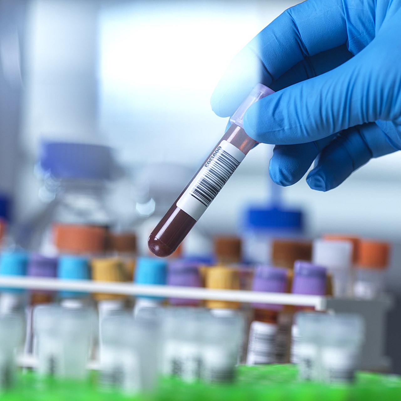 Le test par biopsie liquide utilisé à Gustave-Roussy analyse par séquençage à haut débit un panel de 324 gènes, une technique alternative et tout aussi efficace au test par biopsie titulaire. (SPL/BSIP)