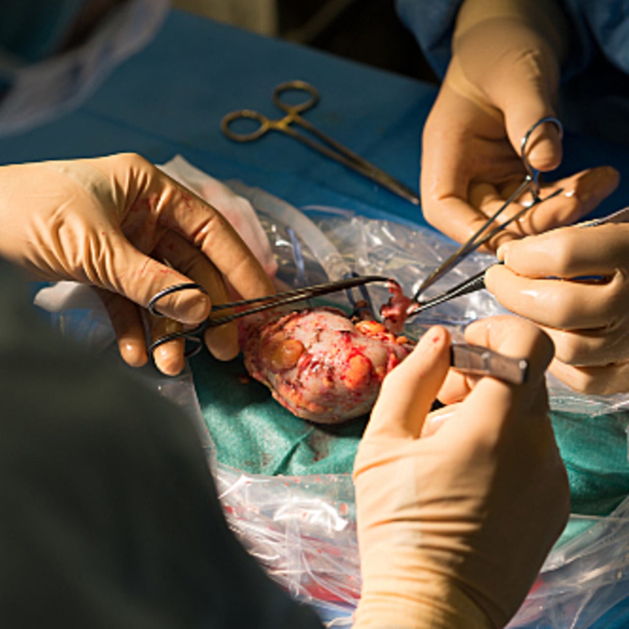 L'estimation haute souhaitée du nombre total de greffes dans le plan Greffe est établie à 8 528 en 2026 (A. Noor/Image Point Fr/BSIP)