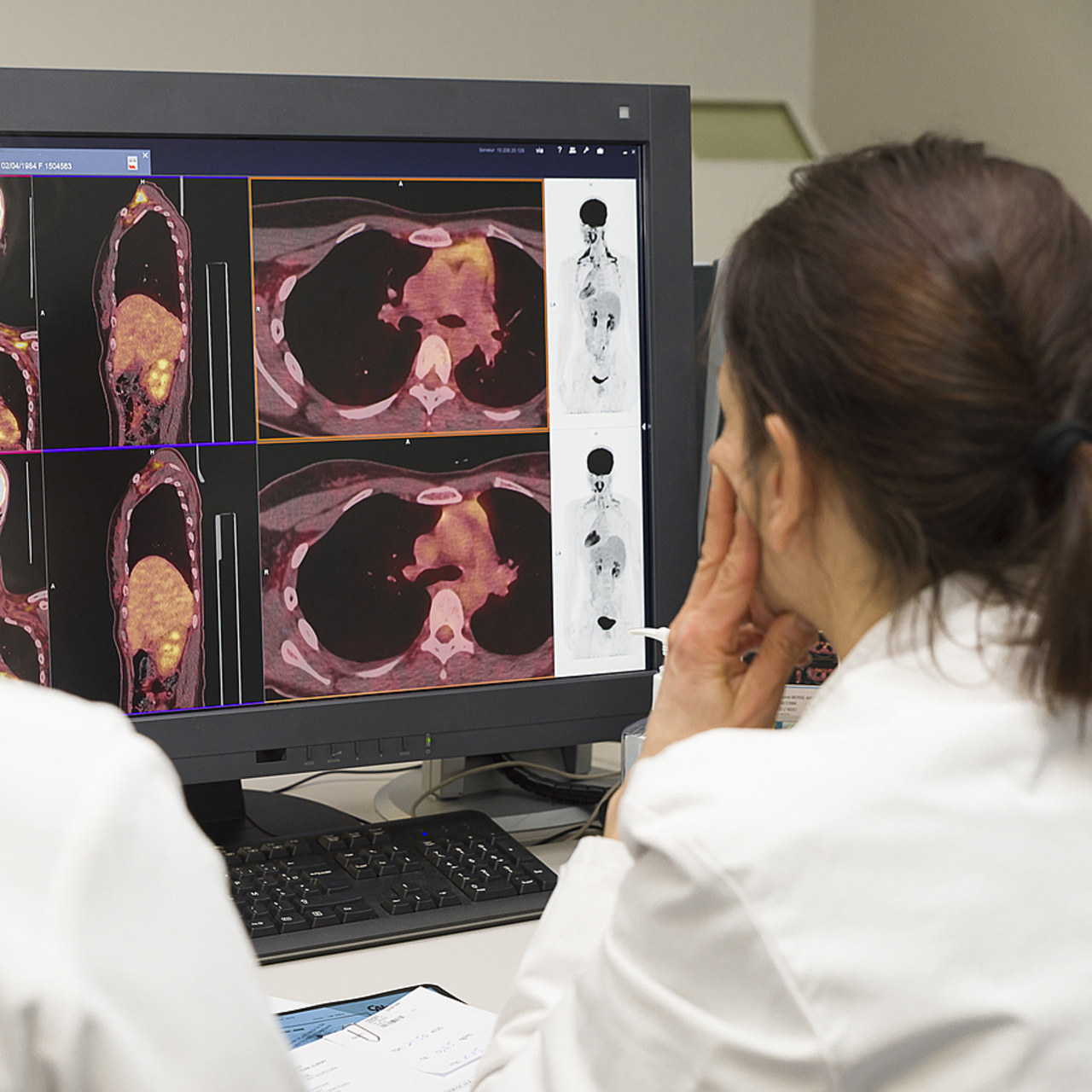 Après quatre années de mise en œuvre du plan européen pour vaincre le cancer, la commission sénatoriale des affaires européennes dresse un premier bilan de ce plan et présente des propositions pour élargir les ambitions européennes. (A.Noor/image Point FR/BSIP)