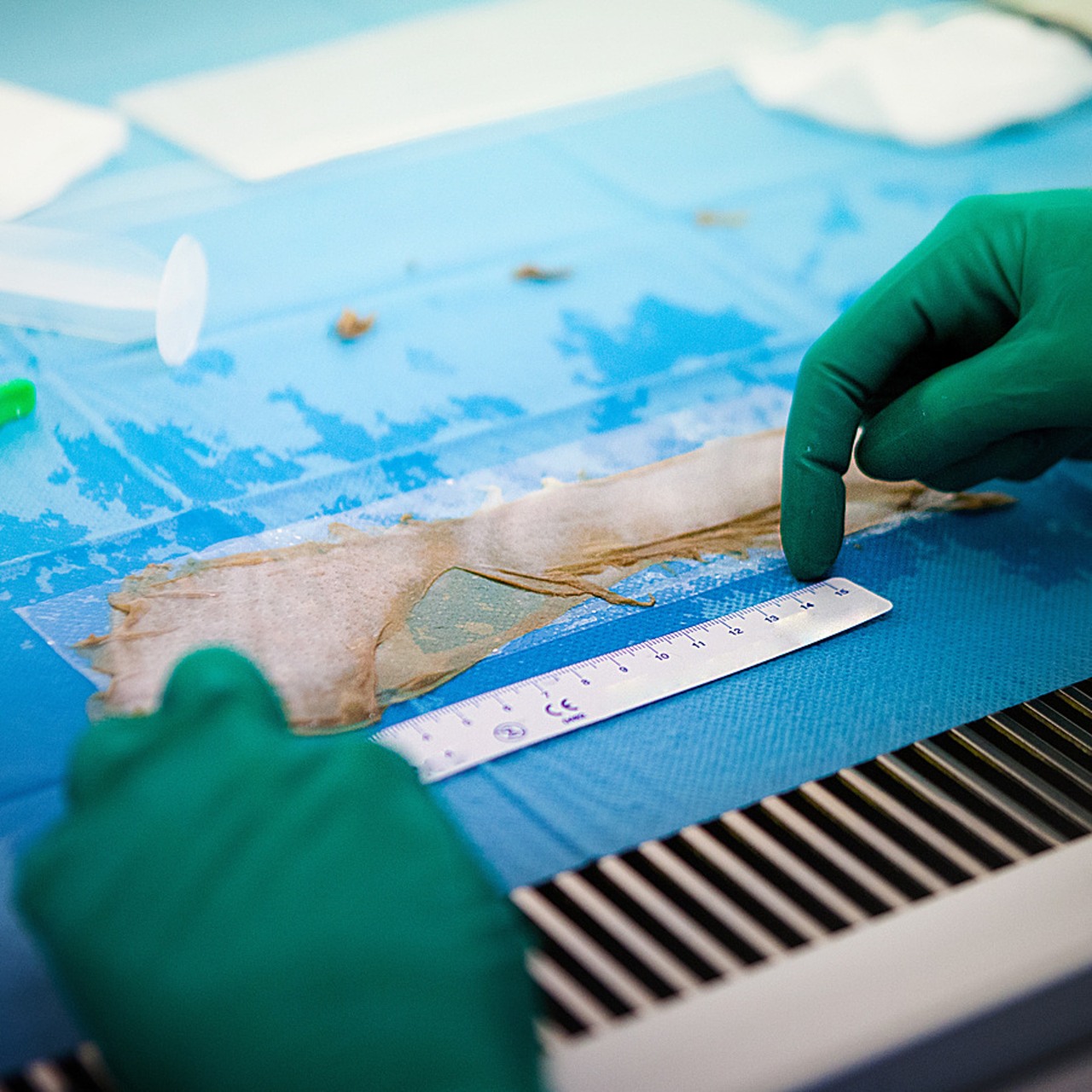 Si la sécurité sanitaire est jugée globalement satisfaisante et le positionnement européen de la France favorable en matière de greffe de tissus, la mission Igas souligne d'importantes faiblesses structurelles. (Amélie Benoist/Image Point FR/BSIP)