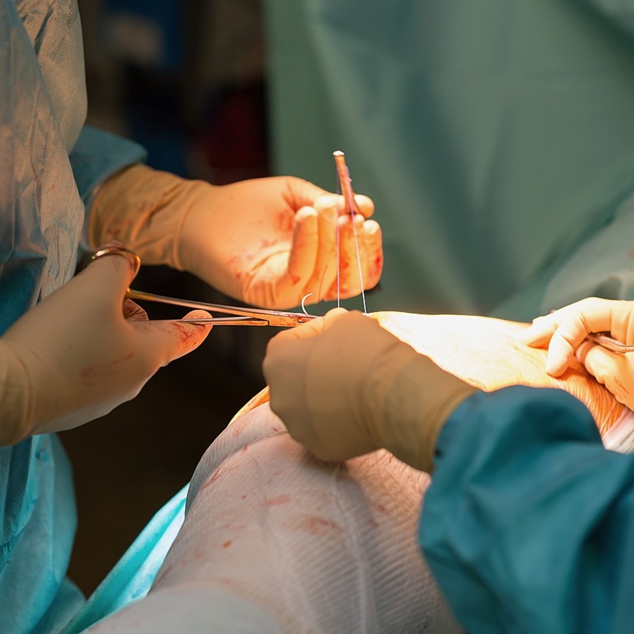 À l'échelon national, les infections du site opératoire sont la troisième cause d'infection nosocomiale, avec un degré d'incidence sur 2 à 3% des interventions chirurgicales. (A. Noor/Image Point FR/BSIP)