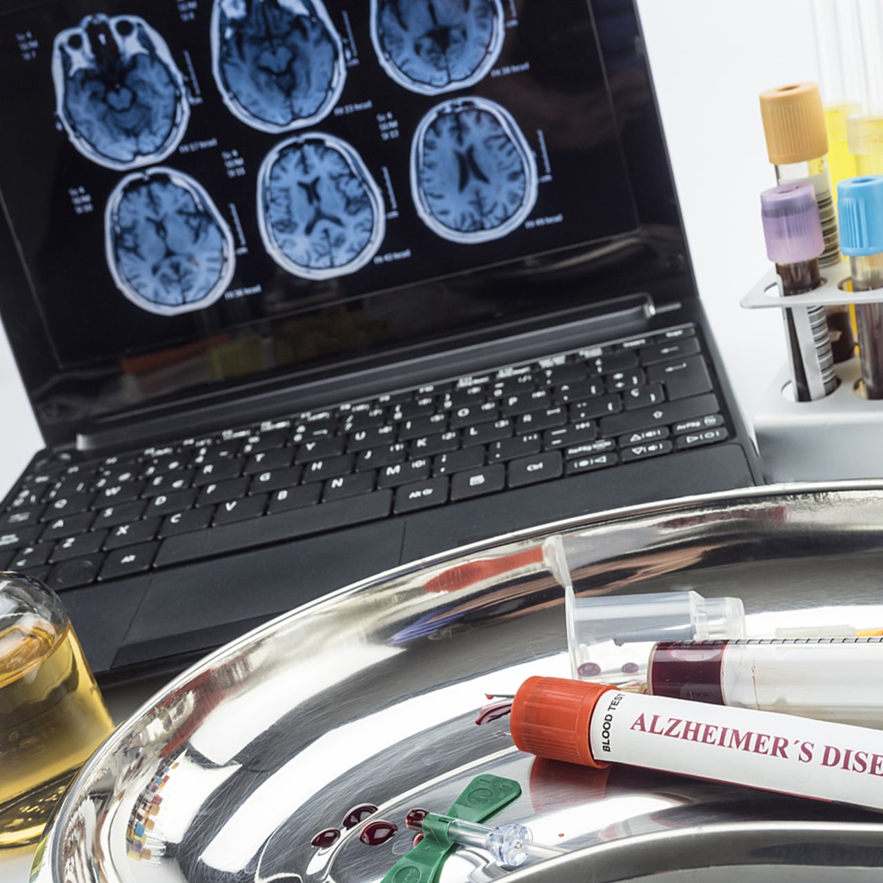 L'un des défis actuels réside dans le diagnostic précoce, alors que les biomarqueurs permettent désormais de décrire l'avancée de la maladie. (SPL/BSIP)