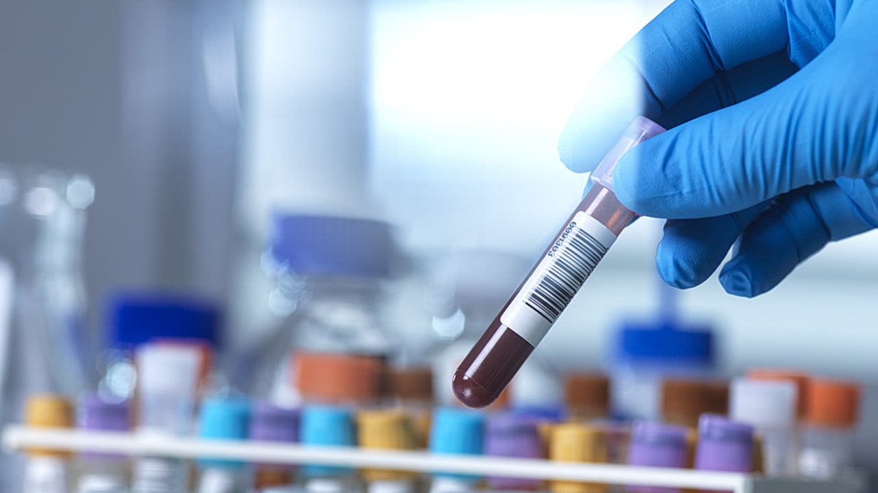 Le test par biopsie liquide utilisé à Gustave-Roussy analyse par séquençage à haut débit un panel de 324 gènes, une technique alternative et tout aussi efficace au test par biopsie titulaire. (SPL/BSIP)